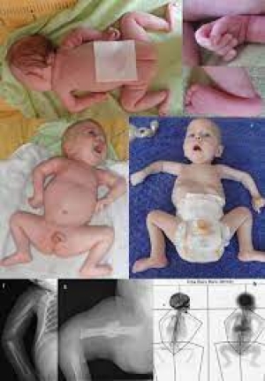 X'e Bağlı Öldürücü İnfantil SMA-2 (X'e Bağlı Spinal Müsküler Atrofi-2)