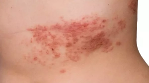 Zona Aşısı Kalp Hastalığı Riskini Azaltıyor