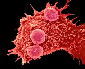 Akciğer Kanserli Hastada İlk Defa CRISPR-Cas9 Tekniği ile Düzeltilmiş Hücre Nakli.....