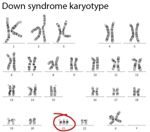 DOWN SENDROMLU HER ÇOCUĞUMUZ KESİNLİKLE KROMOZOM ANALİZİ YAPTIRMALI