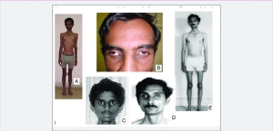 Mitokondriyal nörogastrointestinal ensefalopati (MNGIE) Sendromu